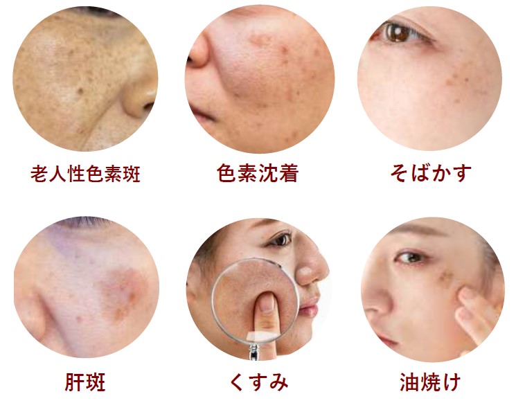 福岡・鹿児島県姶良市のシミの種類