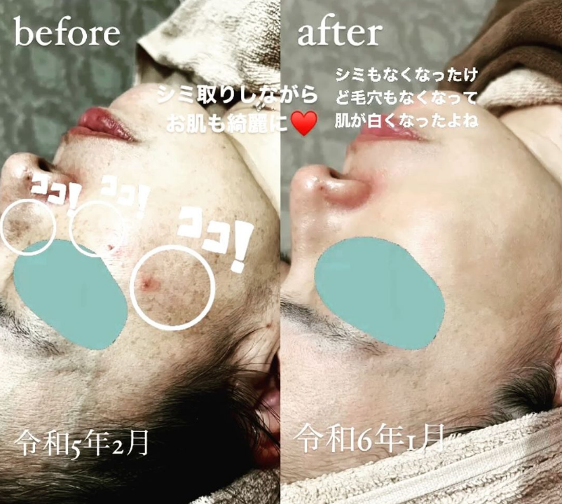 福岡・鹿児島・姶良市のコスメデグレース「シミ取り」