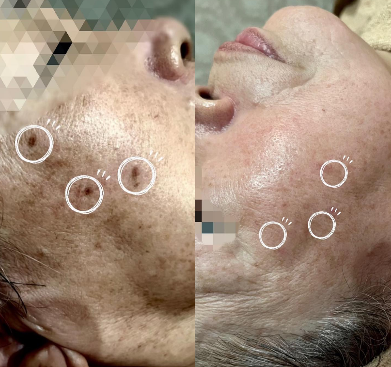 福岡・鹿児島県姶良市・都城のシミ取り