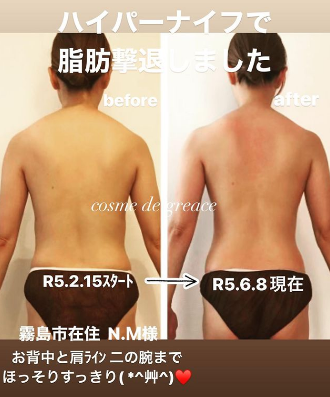 苫小牧・千歳のハイパーナイフの痩身エステ