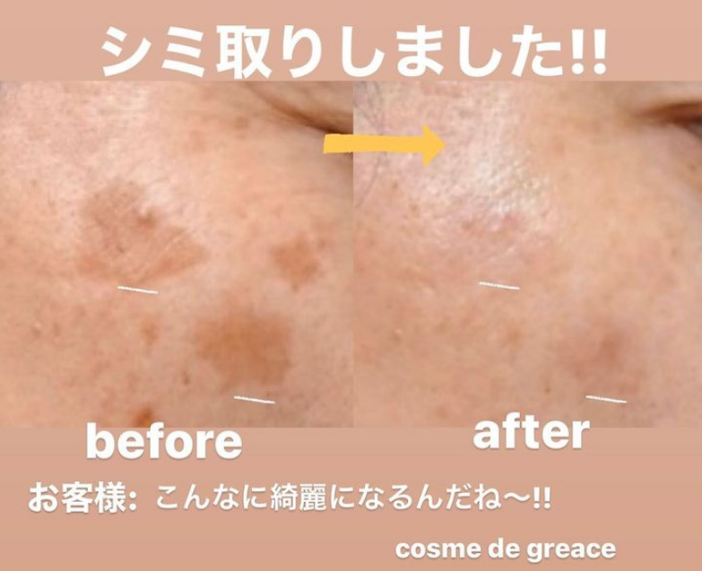 福岡・鹿児島・姶良市のシミ取り