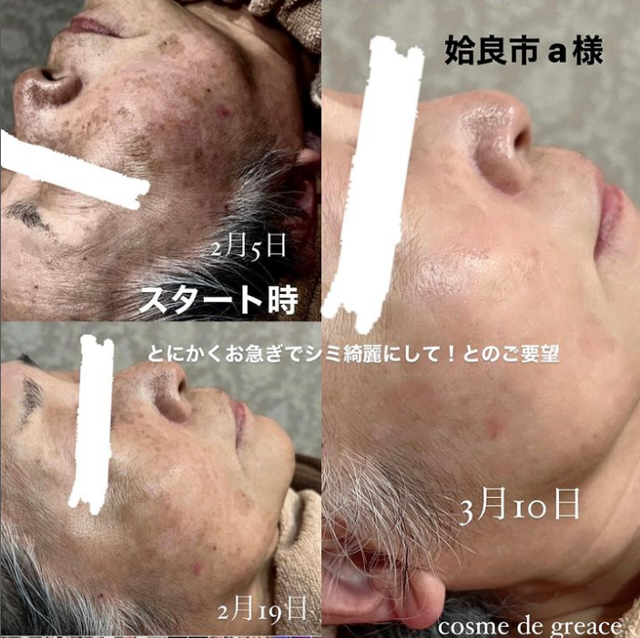 福岡・鹿児島・姶良市のシミ取り