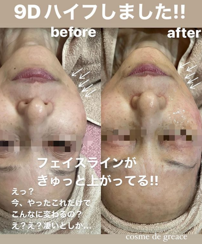 福岡・鹿児島・姶良市のたるみケアフェイシャルエステ