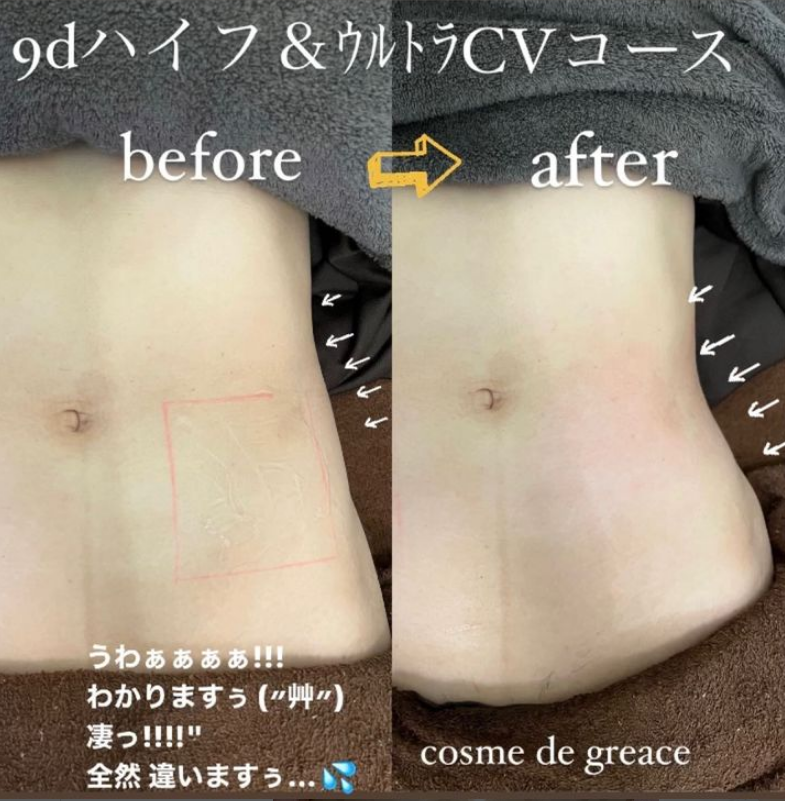 福岡・鹿児島・姶良市のお腹痩せ