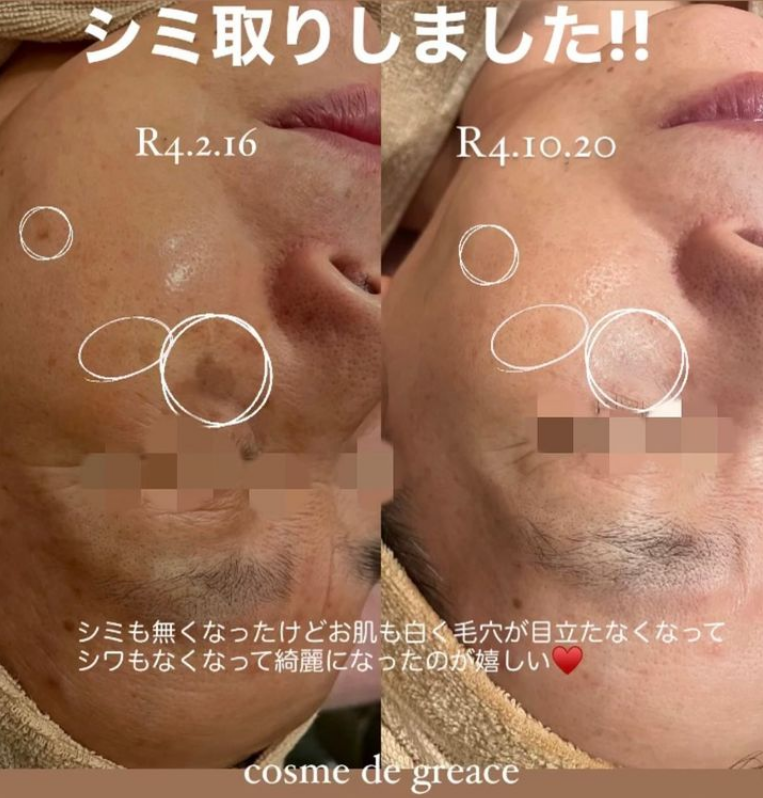 福岡・鹿児島・姶良市のシミ取りエステ