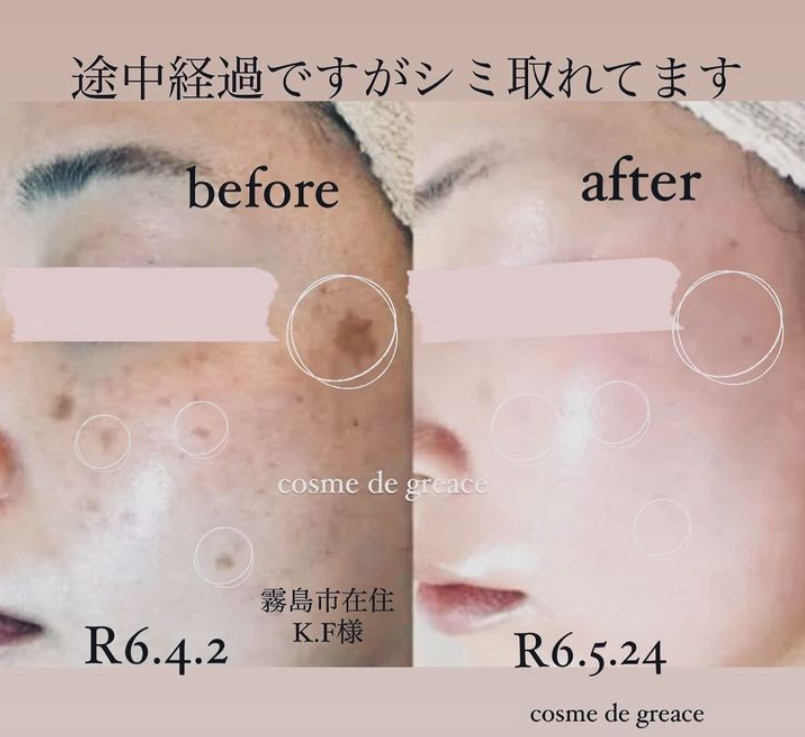 福岡・鹿児島・姶良市・宮崎のシミ取り