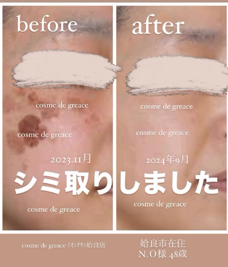 福岡・鹿児島・姶良市・宮崎のシミ取り