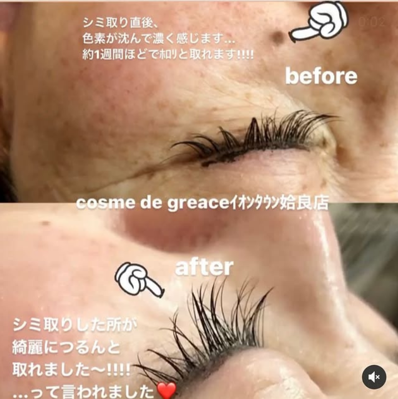 福岡・鹿児島・姶良市・宮崎・都城のシミ取り