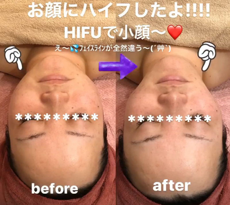 鹿児島・姶良市の小顔