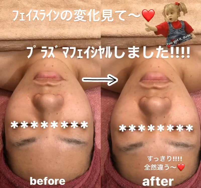 鹿児島・姶良市の小顔