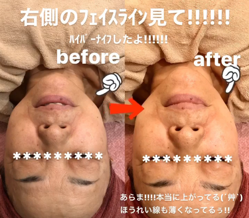 鹿児島・姶良市のほうれい線ケア