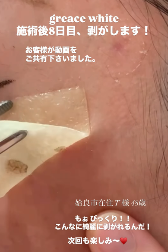 鹿児島・姶良市・宮崎・都城・福岡のシミ取りテープ「グレースホワイト」