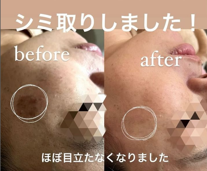 福岡・鹿児島・姶良市・宮崎・都城のシミ取り 福岡・鹿児島・姶良市・宮崎・都城のシミ取り