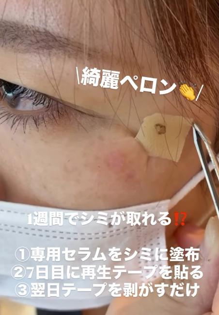 福岡・鹿児島・姶良市・宮崎・都城のシミ取り